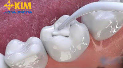 Trám răng có đau không và có an toàn không?