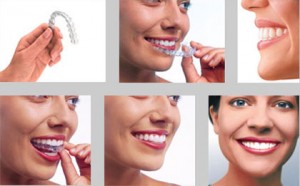 Khay niềng invisalign hiệu quả