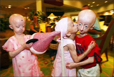 Mengenal Penyakit Progeria atau Penuaan Dini