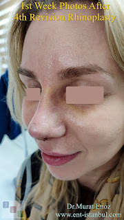 Breathe Implant à Wengen,4. revision nose job, Dent After Rhinoplasty, Complicated 4th Revision Rhinoplasty, Nasal contour irregularities, Postoperative dent issues, Revision rhinoplasty challenges, Rhinoplasty side effects, Nasal structural integrity,