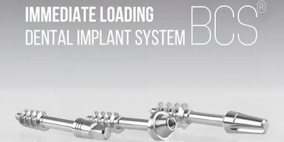 Immediate Loading Implants