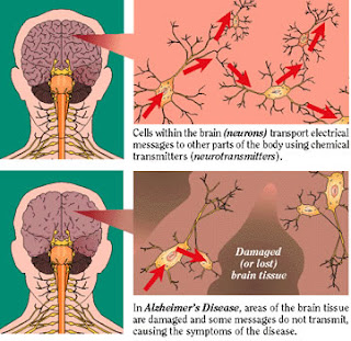 Alzheimer's Disease