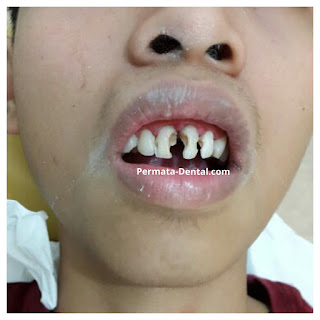 foto, gambar, gigi depan keropos Permata Dental Bali| sebelum dan sesudah gigi keropos diperbaiki di Permata Dental Bali | foto gigi keropos hitam Permata Dental Bali |gigi keropos karena sakit | gigi keropos berlubang | gigi keropos depan| gigi keropos bagian belakang | foto gigi keropos yang sudah diperbaiki Permata Dental Bali |  gigi keropos bagian depan| foto gigi keropos dan patah, foto gigi keropos oleh Permata Dental Bali, Bali Hits, Bali banget, area Bali, Bali kota, area kampus bali. veneer gigi keropos  Bali | veneer gigi keropos badung | veneer gigi keropos nusadua | veneer gigi keropos ngurahrai| veneer gigi keropos denpasar | veneer gigi kropos denpasar kota | veneer gigi keropos Bali | veneer gigi keropos gatsu | |veneer gigi keropos|  depan | veneer gigi keropos  atas | veneer gigi keropos  bawah | veneer gigi keropos  belakang |veneer gigi berlubang bali| veneer gigi berlubang Bali | veneer gigi berlubang nusadua| veneer gigi berlubang ngurahrai| veneer gigi berlubang Badung | veneer gigi berlubang depasar kota | veneer gigi berlubang denpasar| veneer gigi berlubang gatsu| veneer gigi berlubang jimbaran| veneer gigi berlubang bagus Permata Dental Bali | veneer gigi berlubang baik di Permata Dental Bali | veneer gigi berlubang cepat di Permata Dental Bali | veneer gigi berlubang murah di Permata Dental Bali | veneer gigi berlubang aman | veneer gigi berlubang mudah di Permata Dental Bali | veneer gigi berlubang promo Permata Dental Bali | gambar veneer gigi berlubang Permata Dental Bali | gambar sebelum dan sesudah veneer gigi hitam dan berlubang  veneer gigi hitam Bali | veneer gigi hitam Bali | veneer gigi hitam denpasar | veneer gigi hitam jimbaran | veneer gigi hitam nusadua | veneer gigi hitam Bali kota | veneer gigi hitam ngurahrai| veneer gigi hitam badung | veneer gigi hitam gatsu | veneer gigi hitam bagus | veneer gigi hitam baik | veneer gigi hitam cepat di Permata Dental Bali | veneer gigi hitam murah di Permata Dental Bali | veneer gigi hitam aman | veneer gigi hitam mudah di Permata Dental Bali | veneer gigi hitam promo Permata Dental Bali | gambar veneer gigi hitam Permata Dental Bali | gambar sebelum dan sesudah veneer gigi hitam dan berlubang Permata Dental