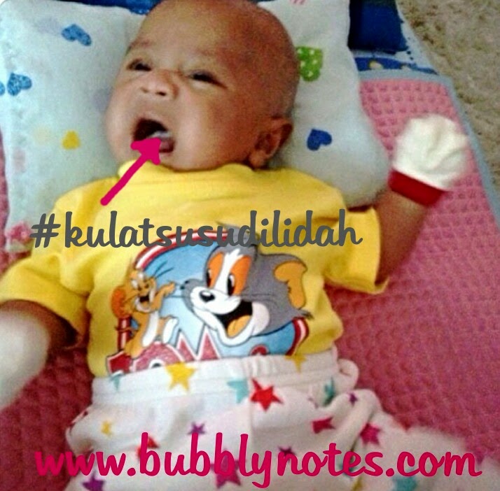 Kulat Susu Di Lidah Bayi - Bubblynotes - Malaysia 