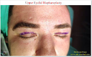 Blepharoplasty,Droopy eyelid surgery,Upper eyelid surgery, in Istanbul, Cost