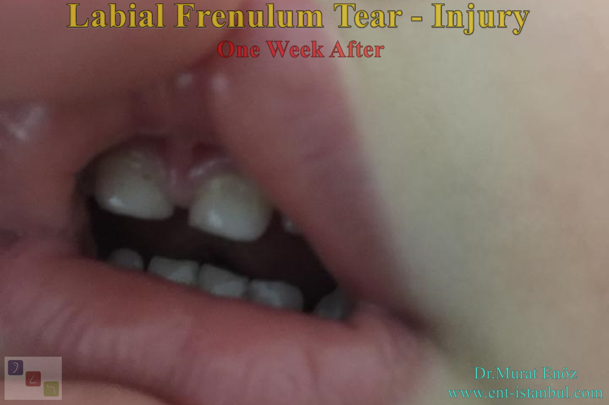 Your Baby's Labial Frenulum