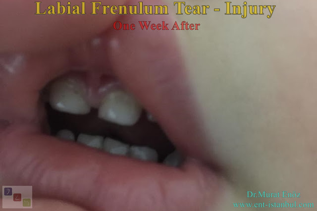 Upper Lip Tie Injury, Liabial Frenulum Tear,