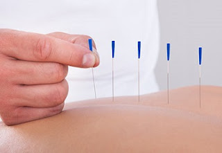 Facts About The Acupuncture Dublin