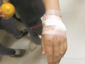 Mujer le quema manos a su hijo de 11 años porque tomó 1,200 pesos 