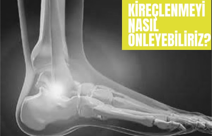 Kireçlenmeyi (Osteoartrit) Nasıl Önleyebiliriz?