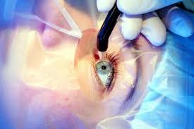 Lasik Laser in Delhi