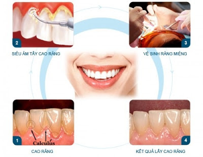 Cạo vôi răng và những vấn đề liên quan