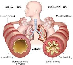 What Is Asthma