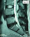 Herniation at the last spinal level, Disc Bulge at the level above that.