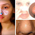 How To Remove Blackheads From Her Nose In 15 Minutes