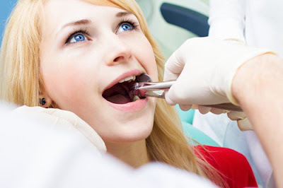 Có cần thiết phải nhổ răng dư hàm trên? 2