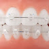Răng mọc lệch gây ra hậu quả gì?