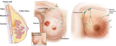 "Traditional Herb Medicine Efficacious Breast Cancer"