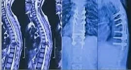 Tuberculosis and Pott’s Disease/spinal tuberculosis.