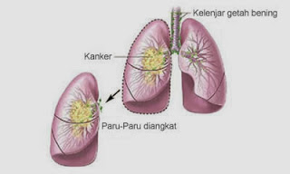 garcia ekstrak kulit manggis