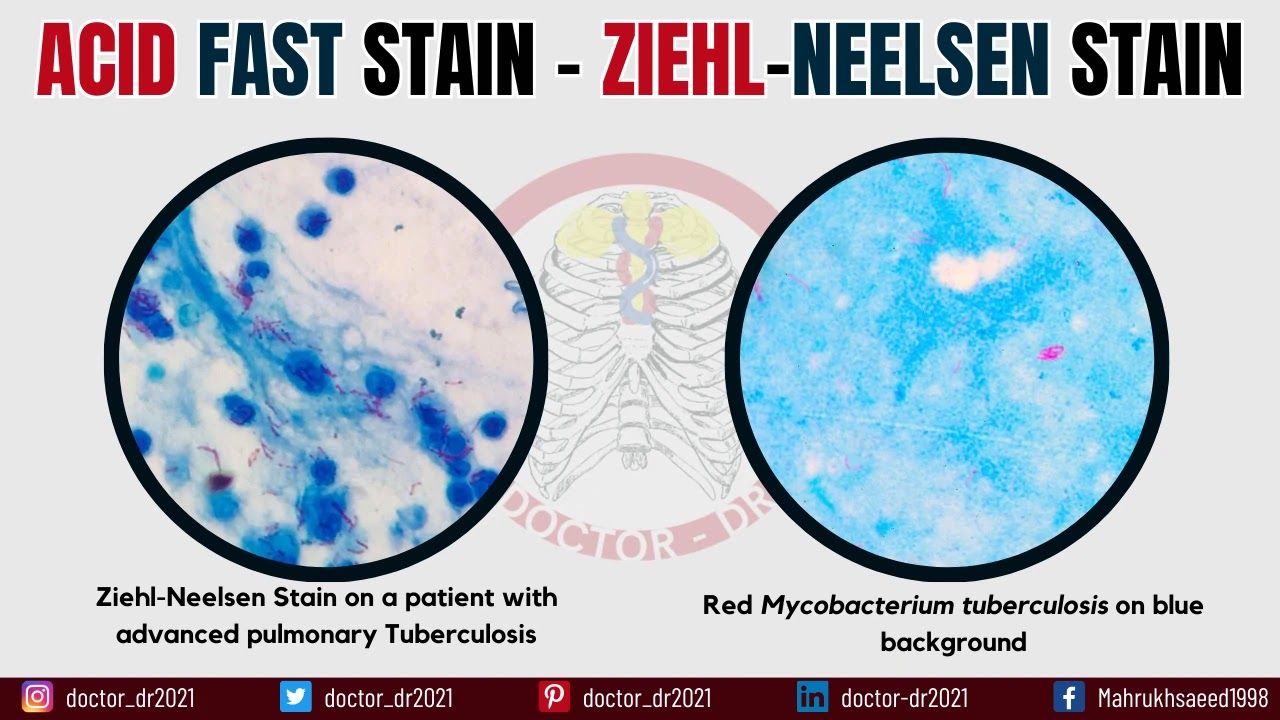 Acid Fast Stain (Ziehl-Neelsen stain) - Principle, Reagents, Procedure and Result Interpretation