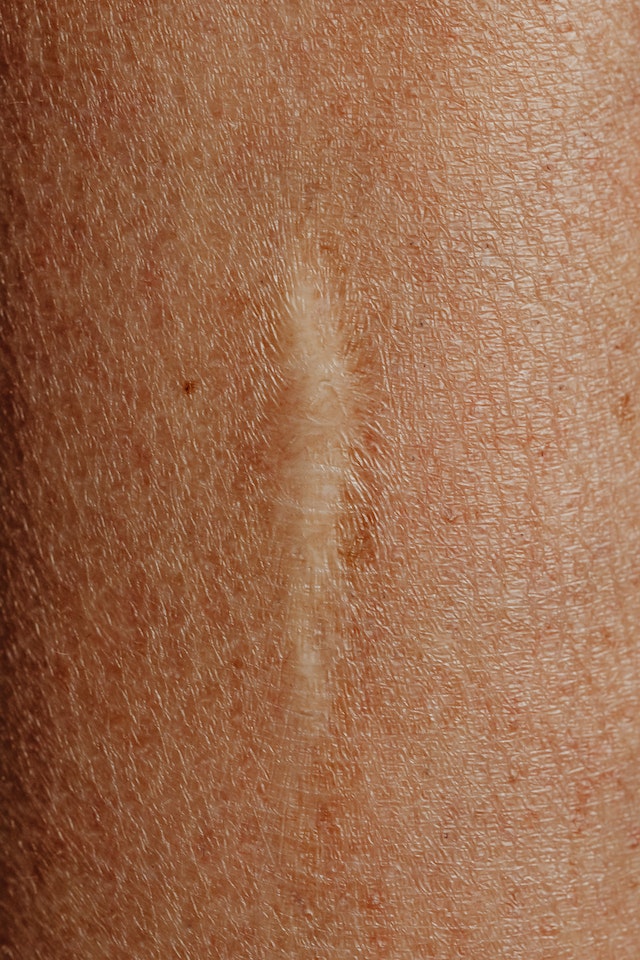 keloid scars
