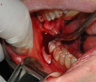 Nhổ răng số 8 có nguy hiểm hay có biến chứng gì không