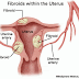 Fibroid Rahim