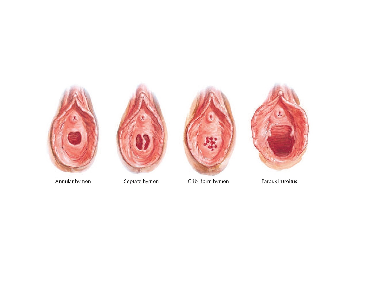 Variations in Hymen Anatomy