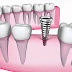 Get Affordable Dental Implants in Danville VA