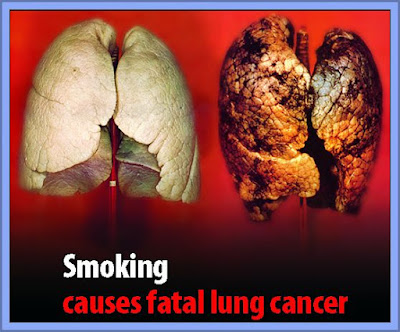 Cigarette Health Warnings .... Graphic