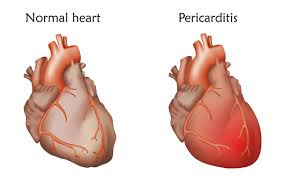 Acute pericarditis