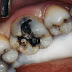 Trám răng sâu giá bao nhiêu áp dụng cho răng hàm?