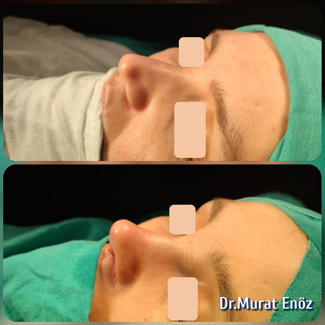 Augmentation rhinoplasty, Altering the nose size, Increasing the nose volume