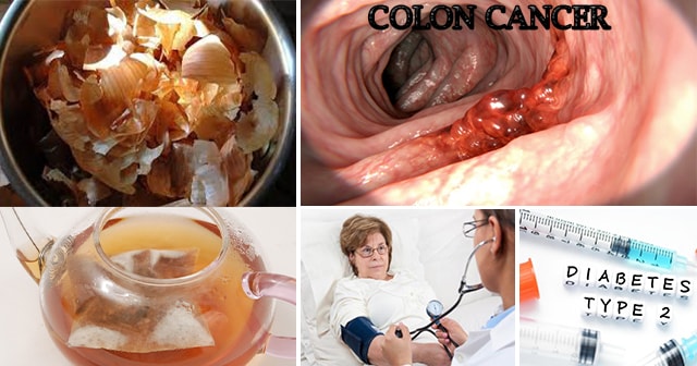 Gamutin ang Colon Cancer, Type 2 Diabetes, Highblood Pressure at Sakit sa Puso sa Pamamagitan ng Balat ng Sibuyas. Alamin at Basahin na dito.