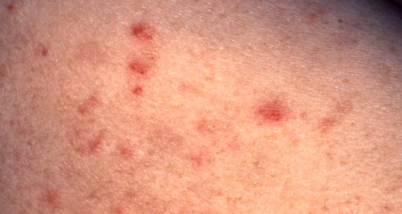 Allergy+to+penicillin+rash