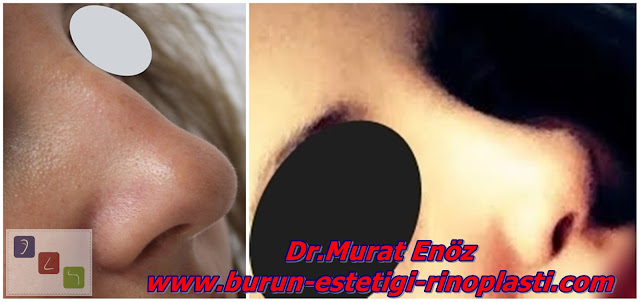 Burun estetiği - Rinoplasti - Burun estetiği öncesi ve sonrası görüntüleri - Dr.Murat Enöz burun estetiği fotoğrafları - Estetik burun ameliyatı - Burun estetiği ameliyatı tanımı - Burun estetiği nasıl yapılır? - Burun estetiği nedir? - Burun estetiği teknikleri - Burun estetiği sonrası - Burun estetiği İstanbul