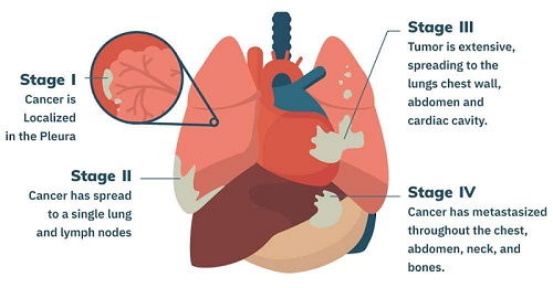 Prognosis of Stage 4 Mesothelioma 1