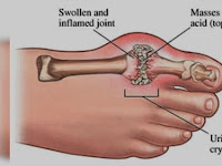 Buahan Obat Asam Urat