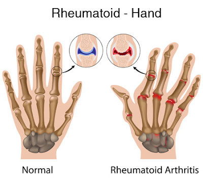 How to treat rheumatoid arthritis