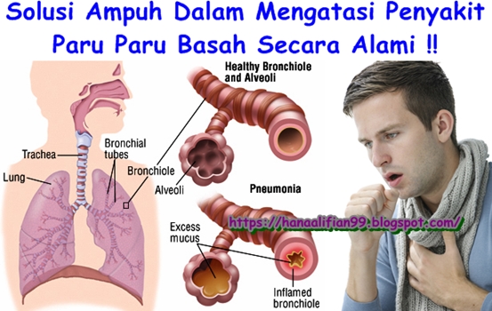 Cara Mengobati Paru Paru Basah Sampai Sembuh Total