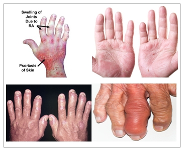 Cara Mengobati Radang Sendi Psoriasis (Psoriatic Arthritis)