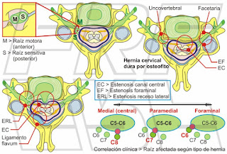 Hernia de disco a nivel cervical