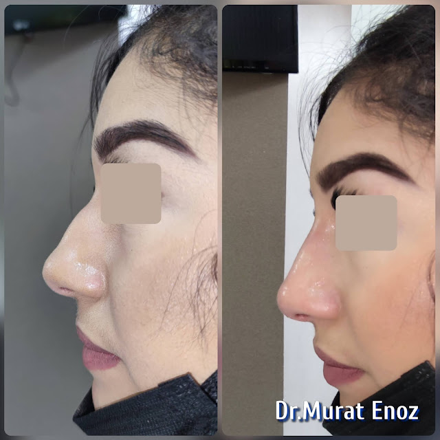 The 5 Minute Nose Job in Istanbul,Nose filler injection Turkey,