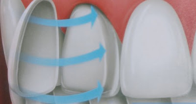 Răng sứ Veneer và những lợi ích nên biết
