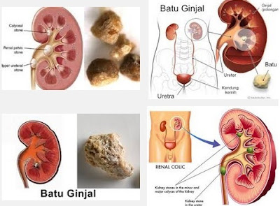 Obat Penghancur Batu Ginjal Yang Paling Manjur di Apotik 100% Aman Utk Semua Usia