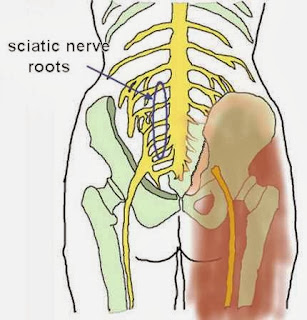 sciatica pain treatment