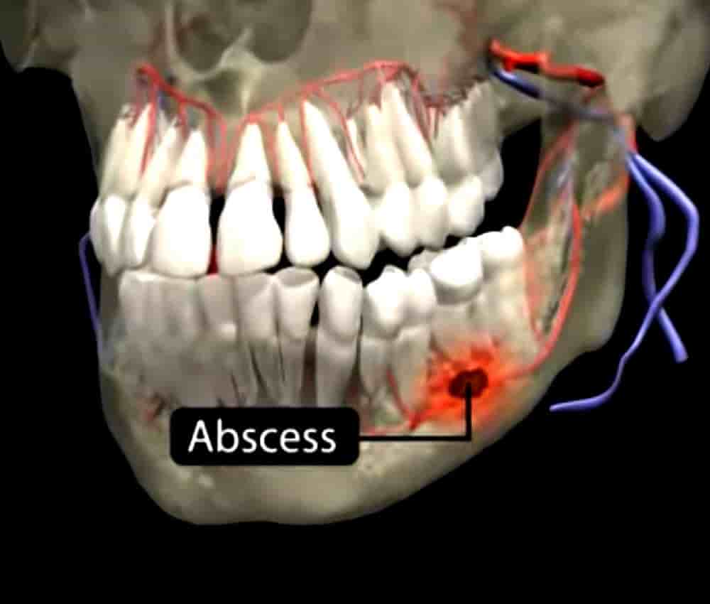 DENTAL ABSCESS