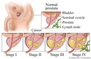 Obat Kanker Prostat