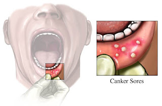 Medicine For Sore Throat And Cough While Pregnant : 5 Rapidly Ideas To Cure Cold Sore